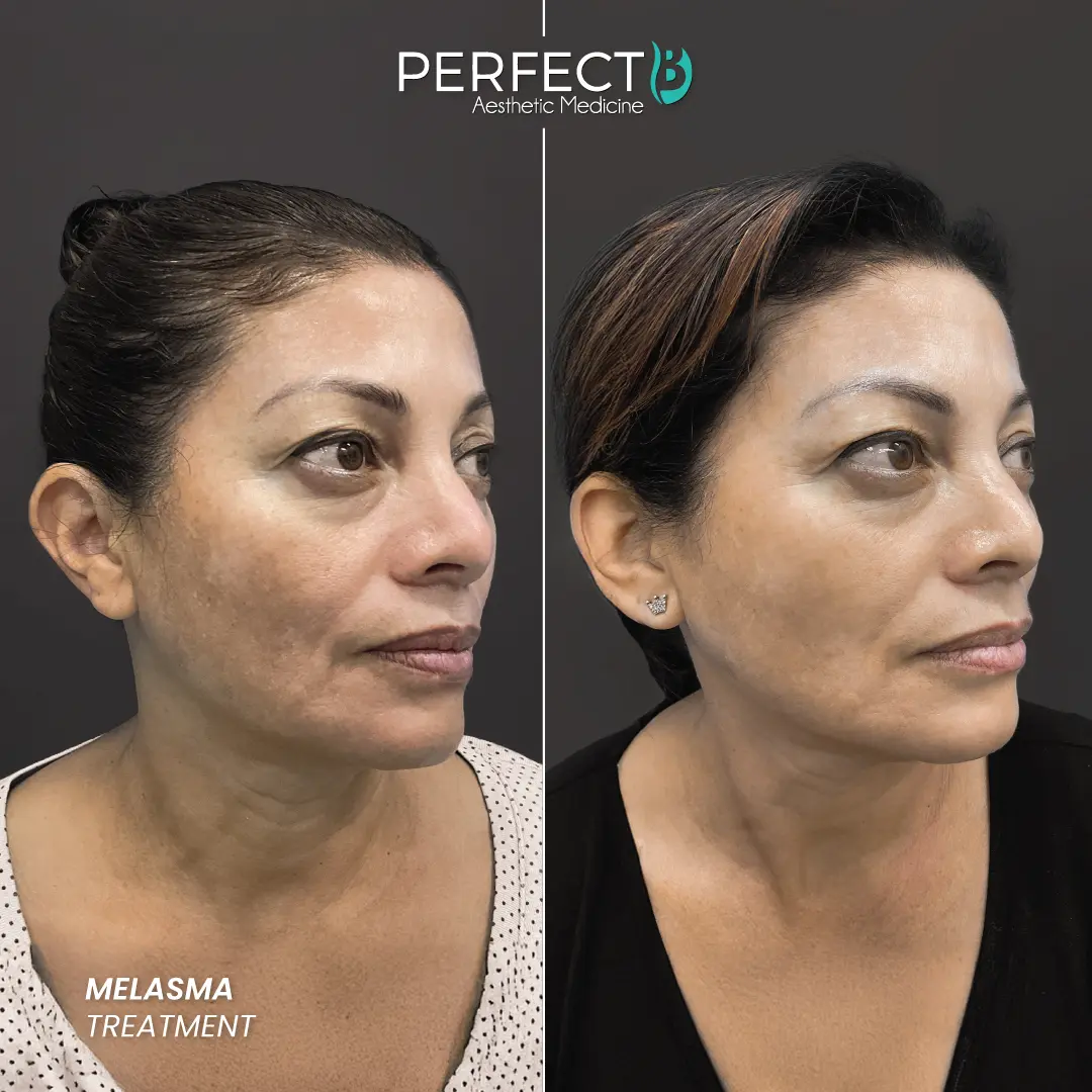 4500_2 Skin-Brightening-Tx Results-Pictures