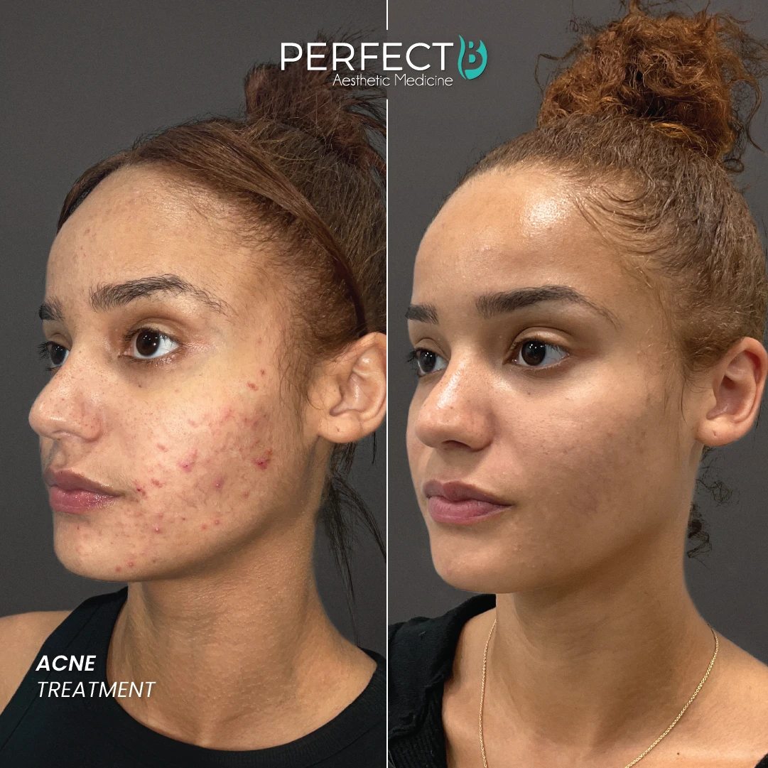 Acne Treatment - Perfect B - Case 4004 - 1080 x 1080