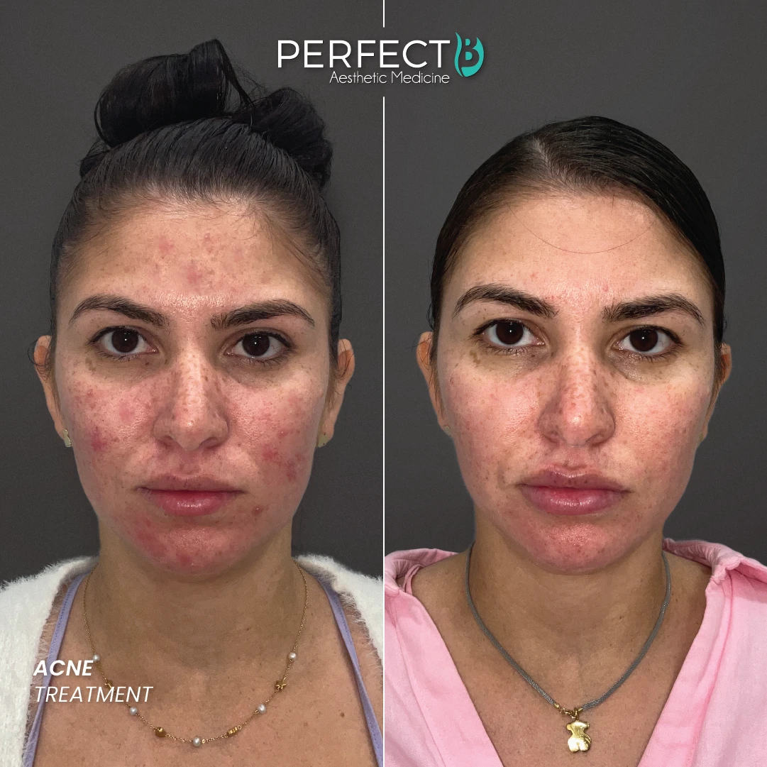 Acne Treatment - Perfect B - Case 4032 - 1080 x 1080