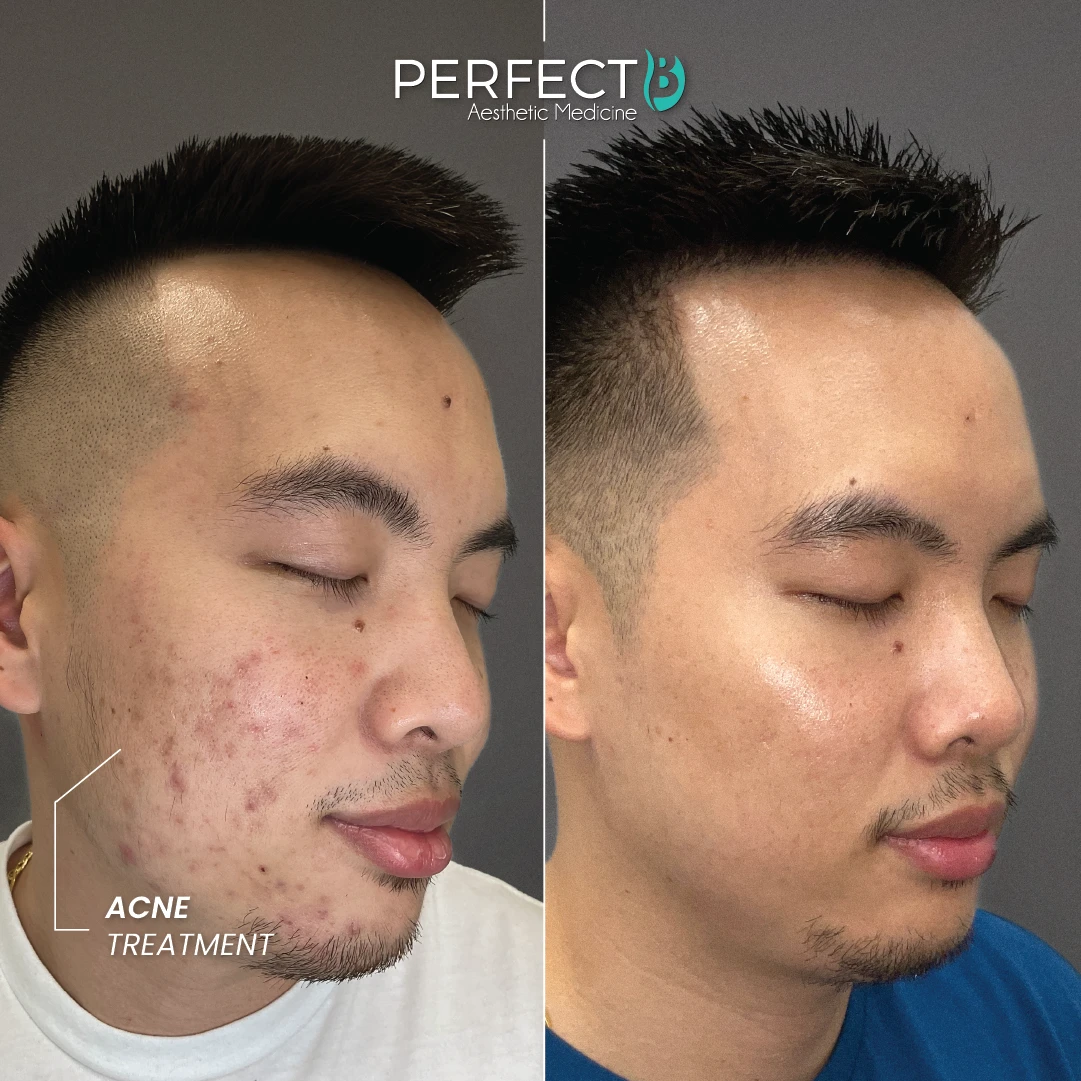 Acne Treatment - Perfect B - Case 5013 - Results Image - 1080 x 1080