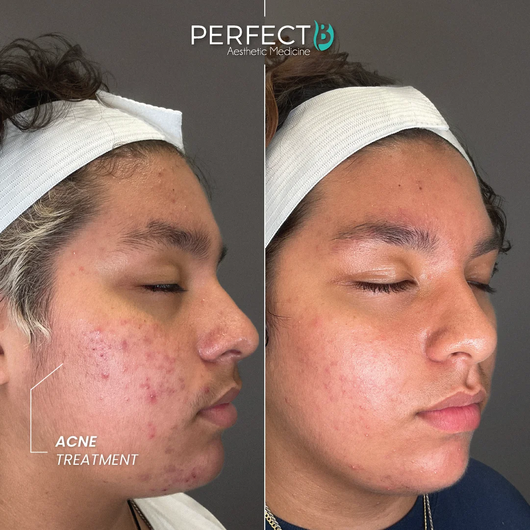 Acne Treatment - Perfect B - Case 5015 - Results Picture - 1080 x 1080
