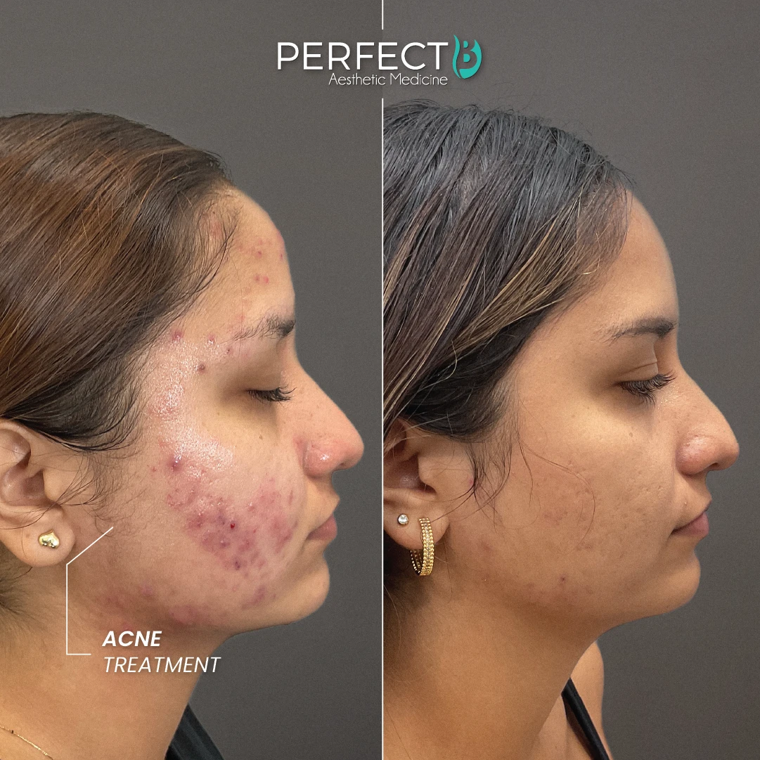 Acne Treatment - Perfect B - Case 5015 - Results Image - 1080 x 1080