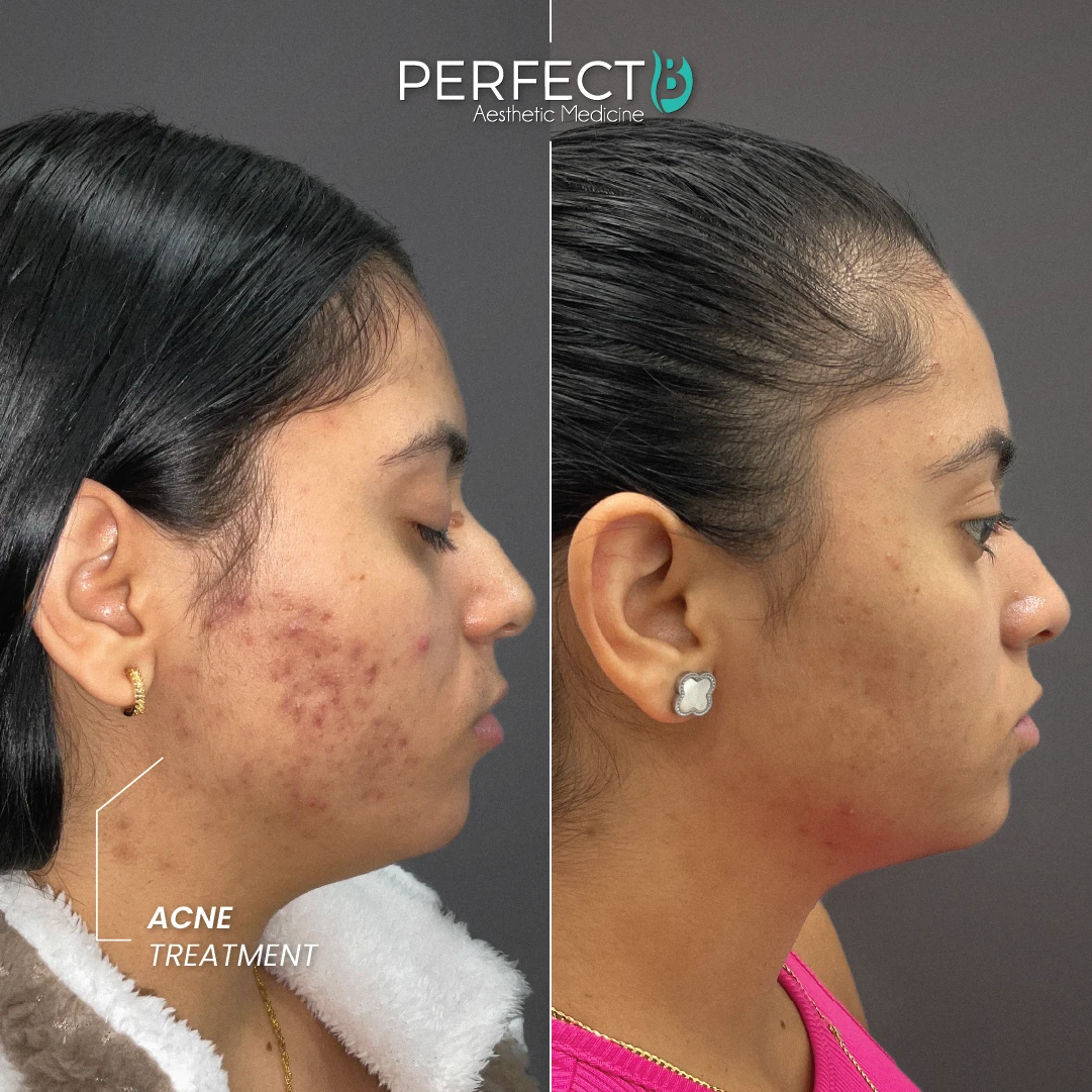 Acne Treatment - Perfect B - Case 5016 - Results Pictures 1080 x 1080