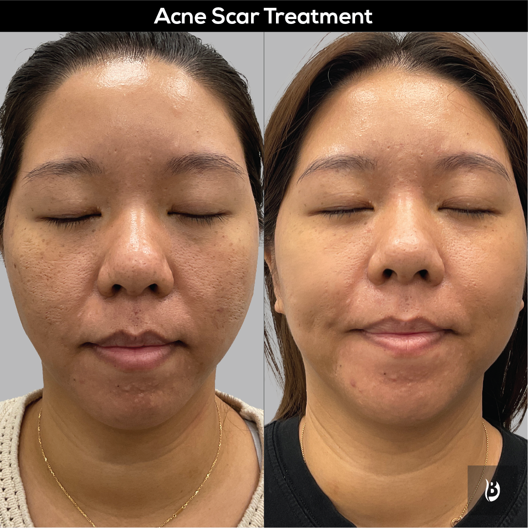 Skin Rejuvenation Treatment Results Picture