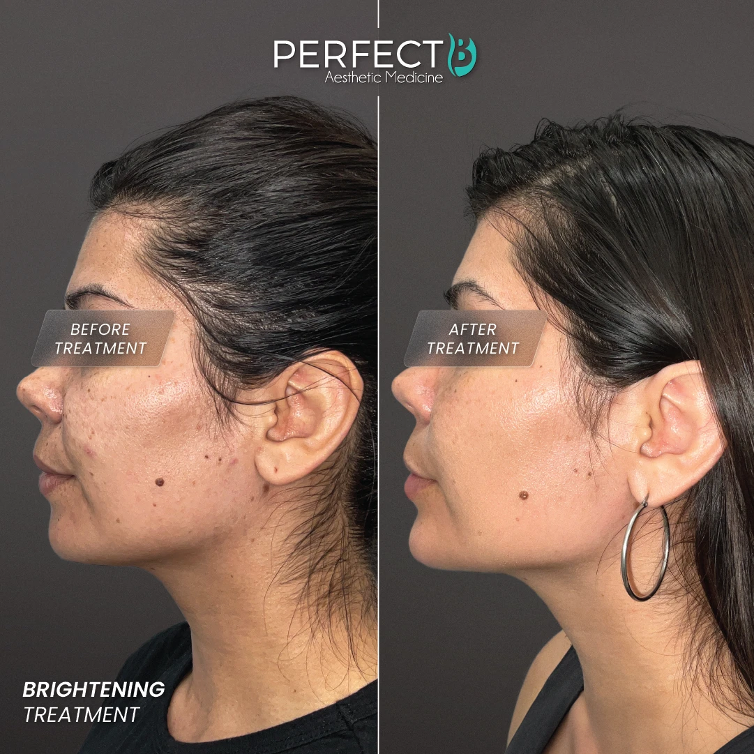 Brightening Treatment (Lesion Removal) - Perfect B - Results Image - Case 4501 - 1080 x 1080