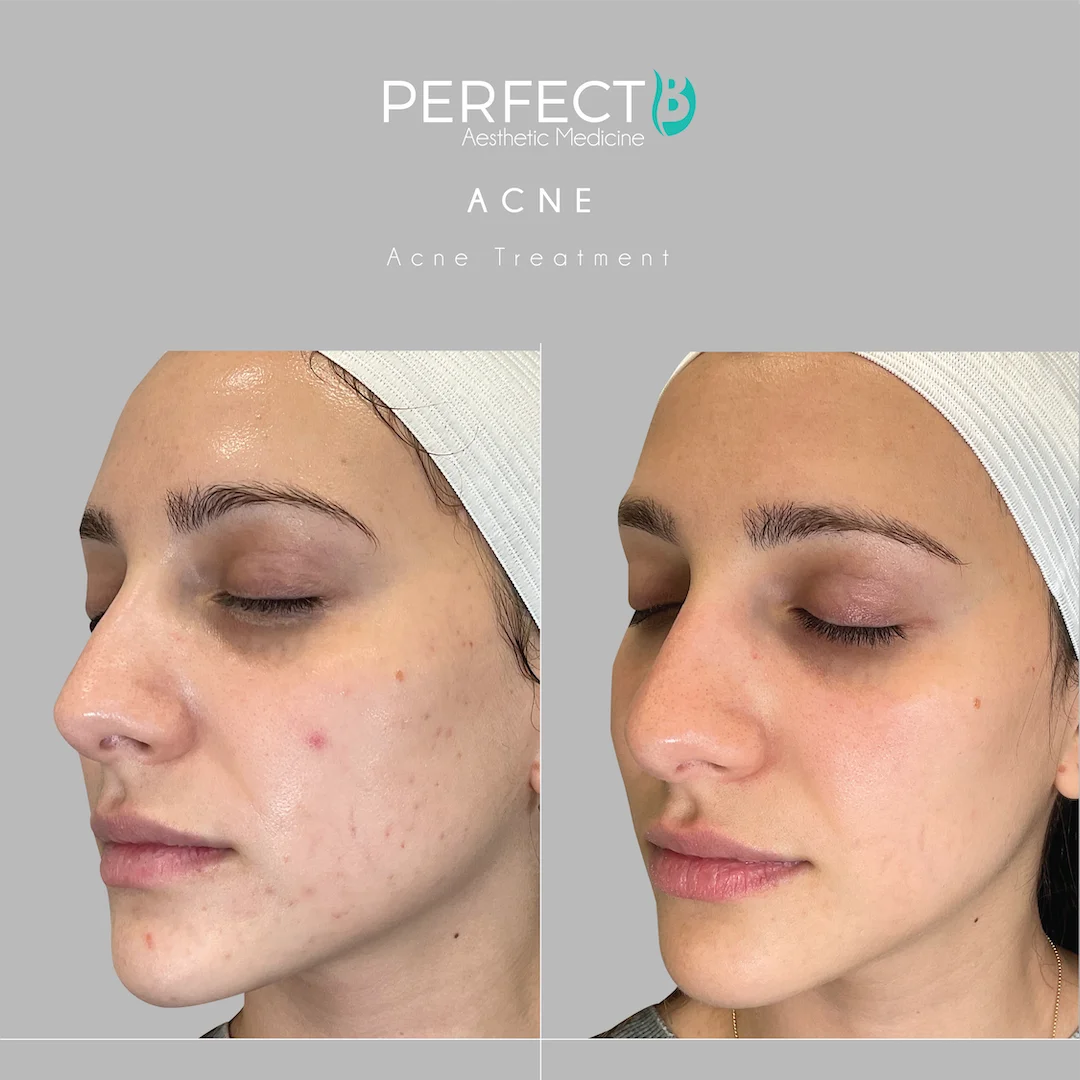 Acne Scars Treatment at Perfect B Case 1102