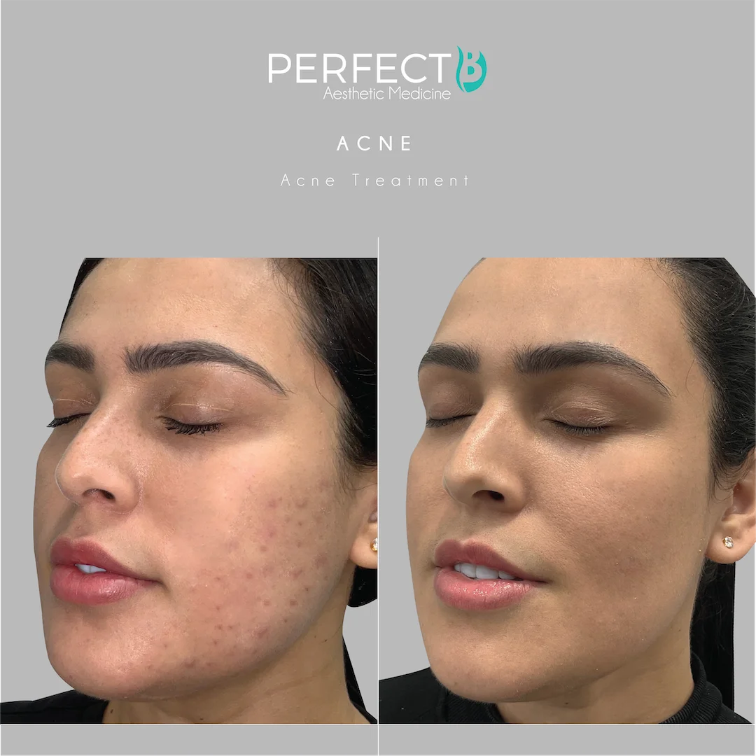 Acne Scars Treatment at Perfect B Case 1104