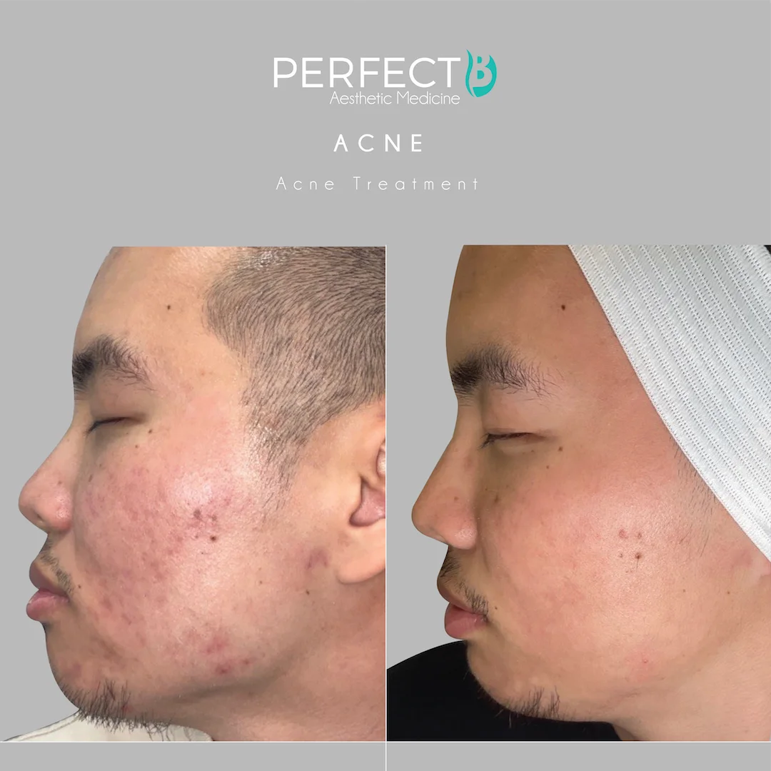 Acne Scars Treatment at Perfect B Case 1112
