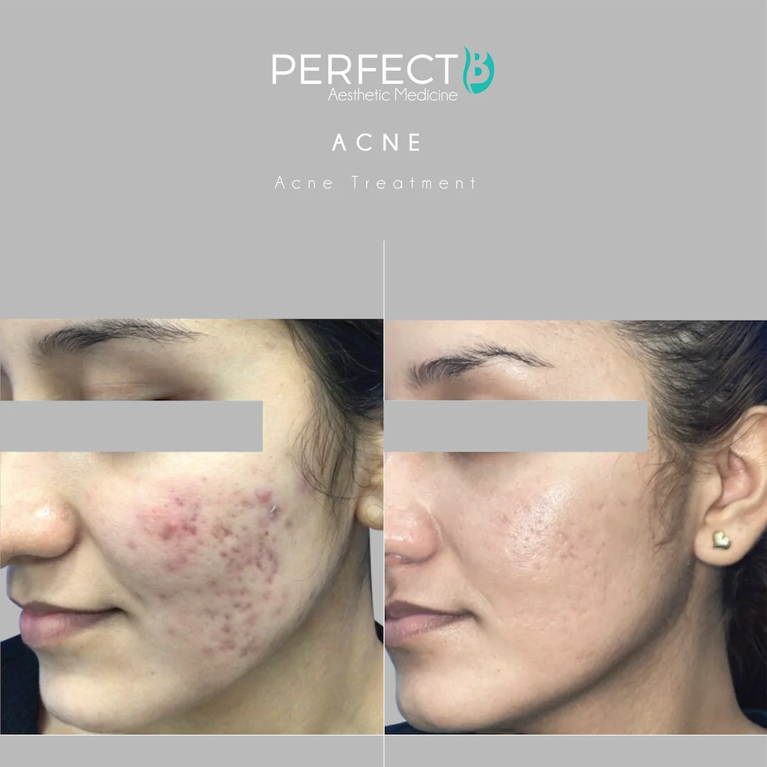 Acne Scars Treatment at Perfect B Case 1144