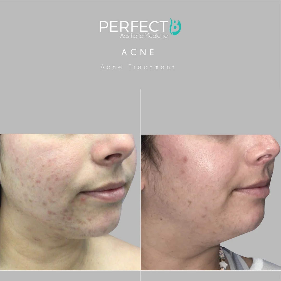 Acne Scars Treatment at Perfect B Case 1175