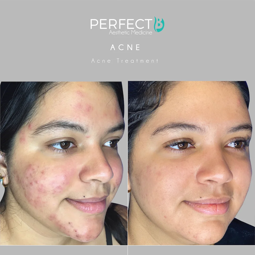 Acne Scars Treatment at Perfect B Case 1179