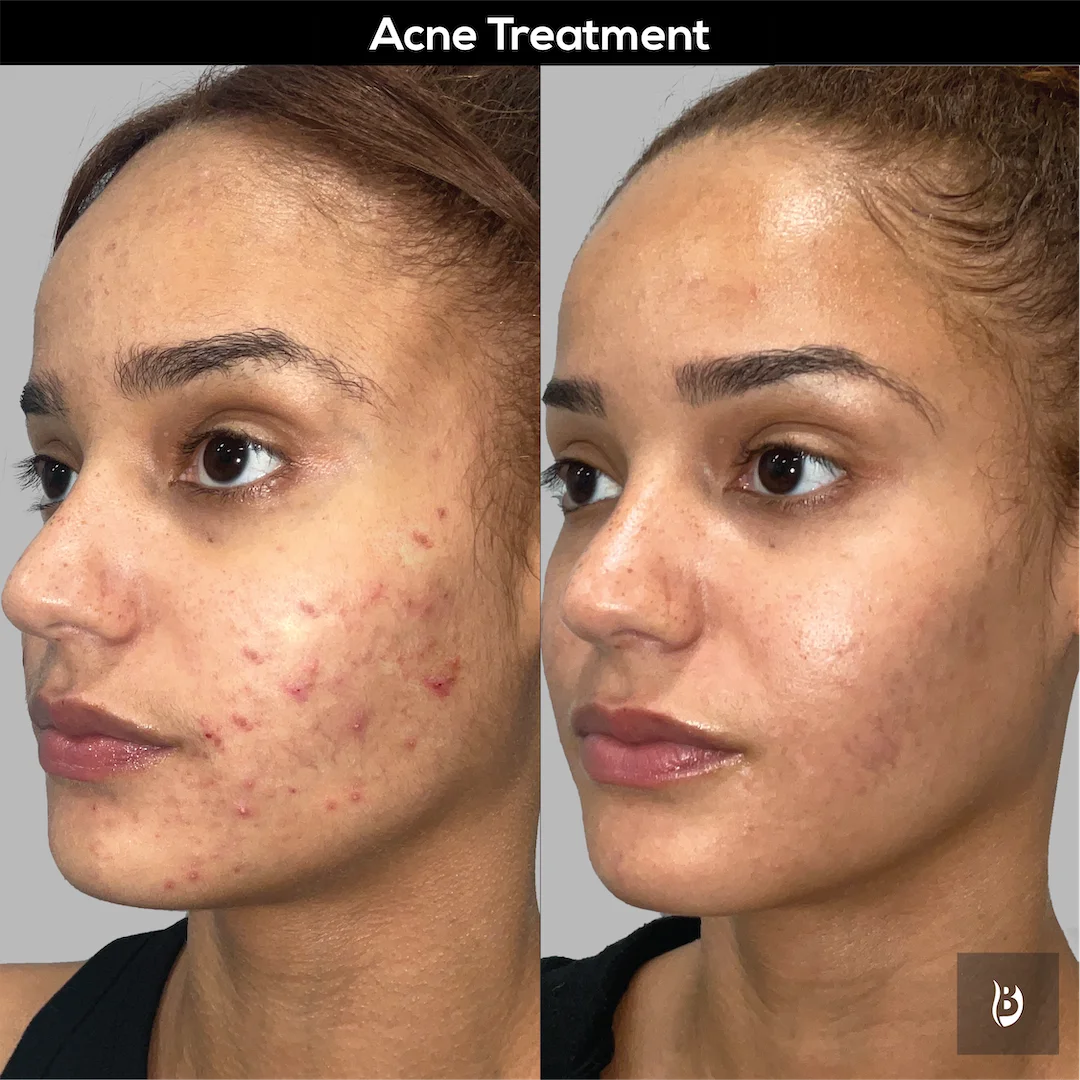 Acne Scars Treatment at Perfect B Case 5003