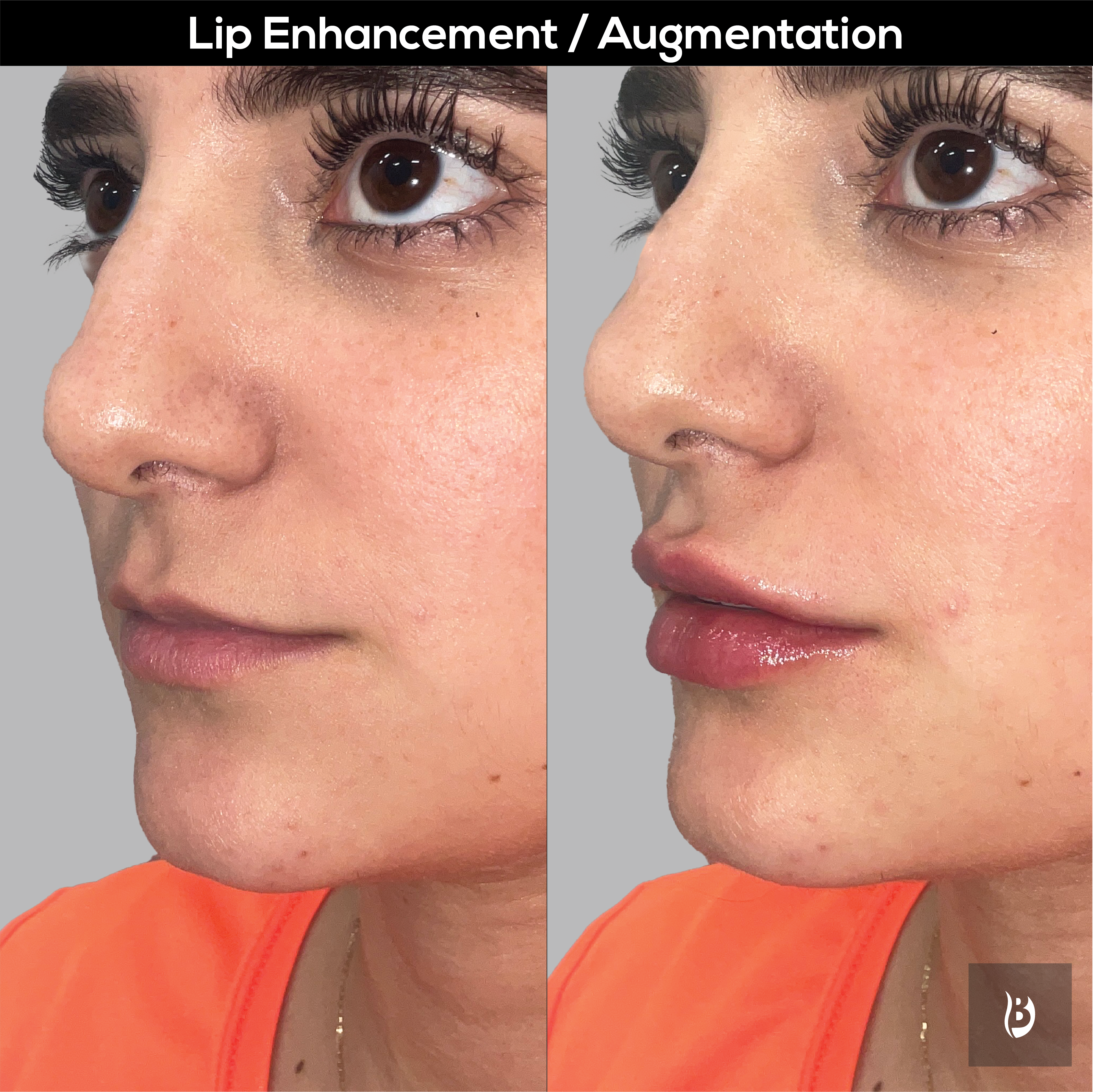 lip enhancement augmentation