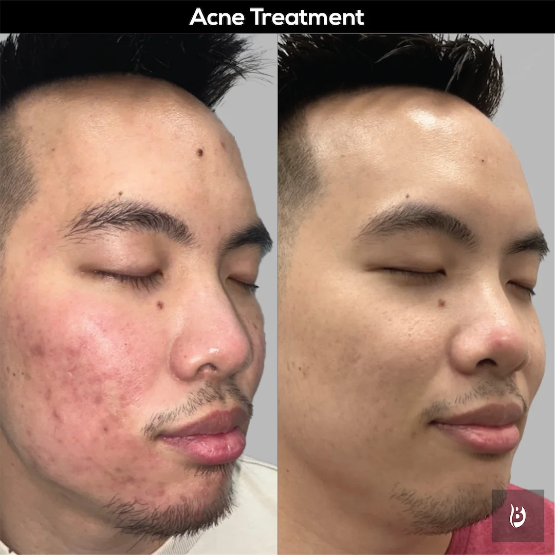 Acne Scars Treatment at Perfect B Case 5013