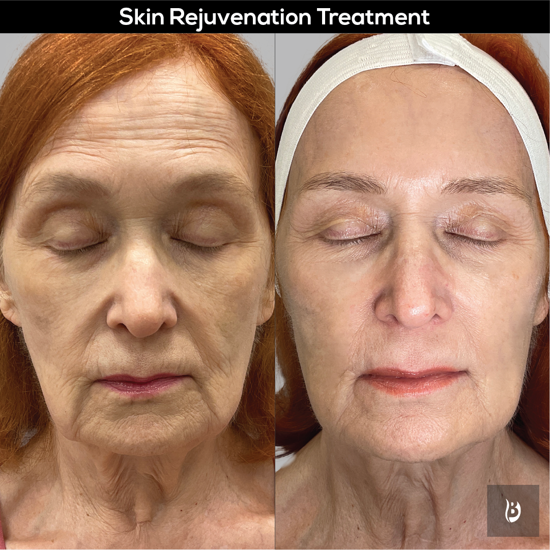 Skin Rejuvenation Treatment Results Picture