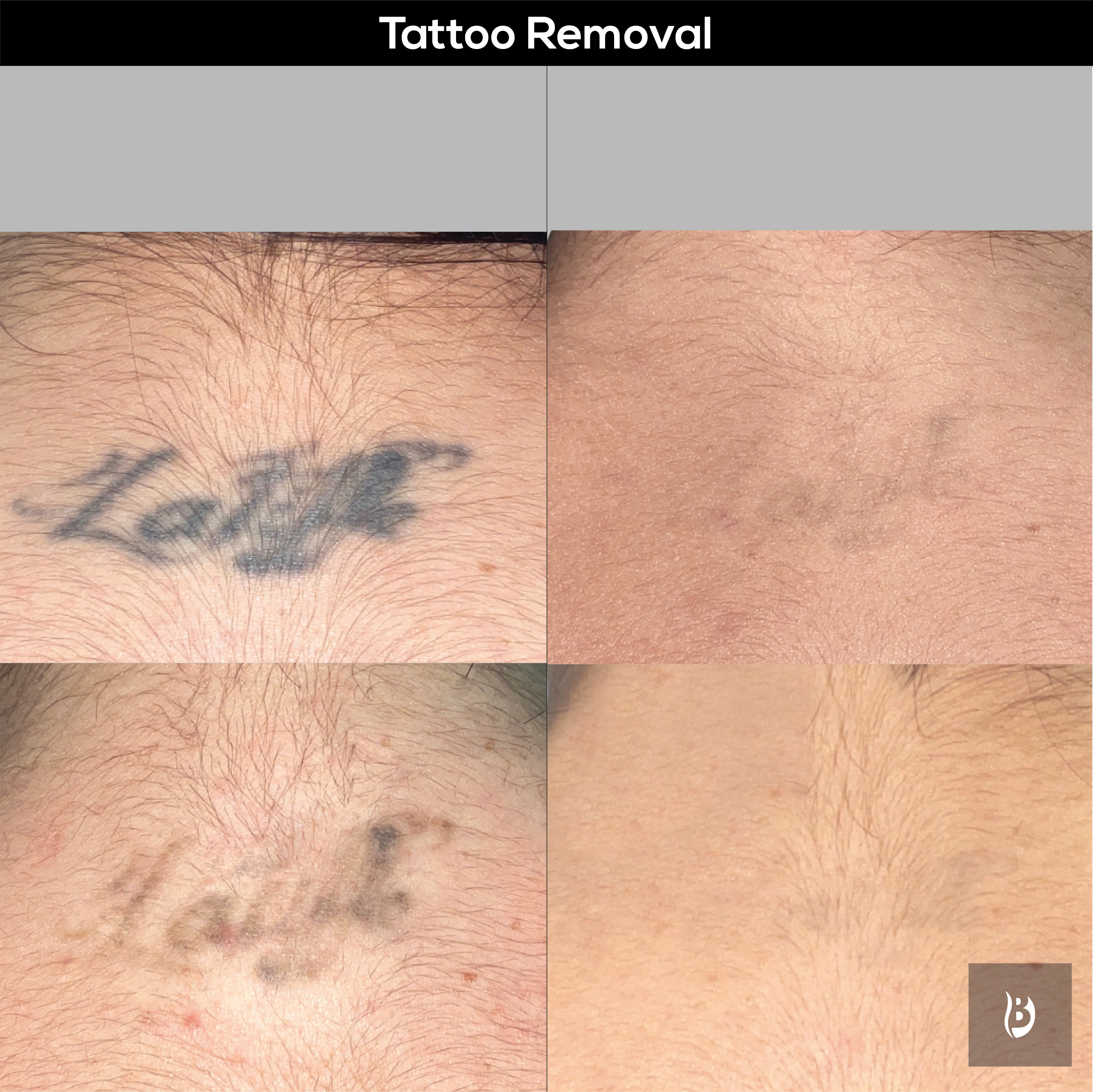tattoo removal case