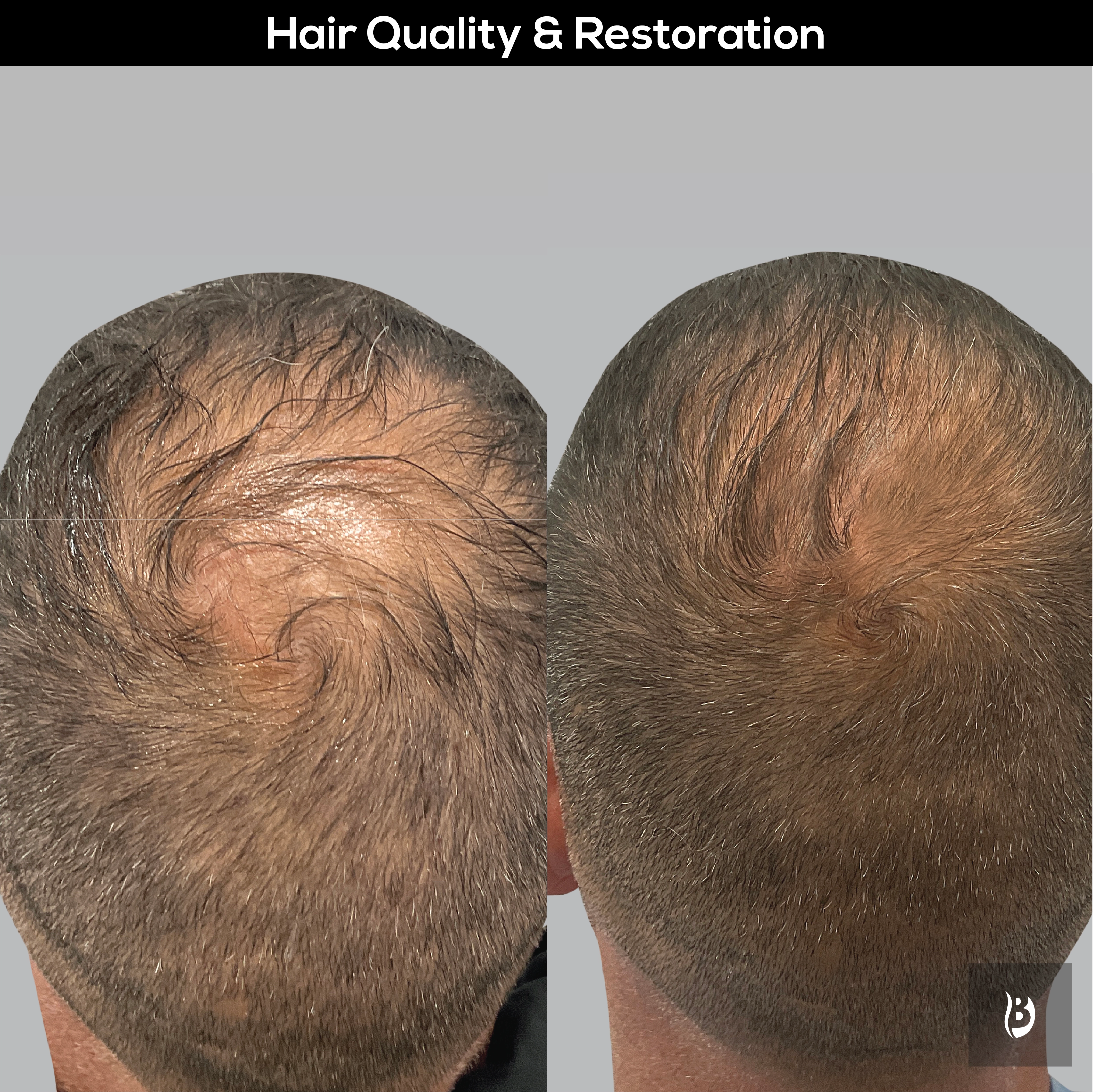 hair loss restauration