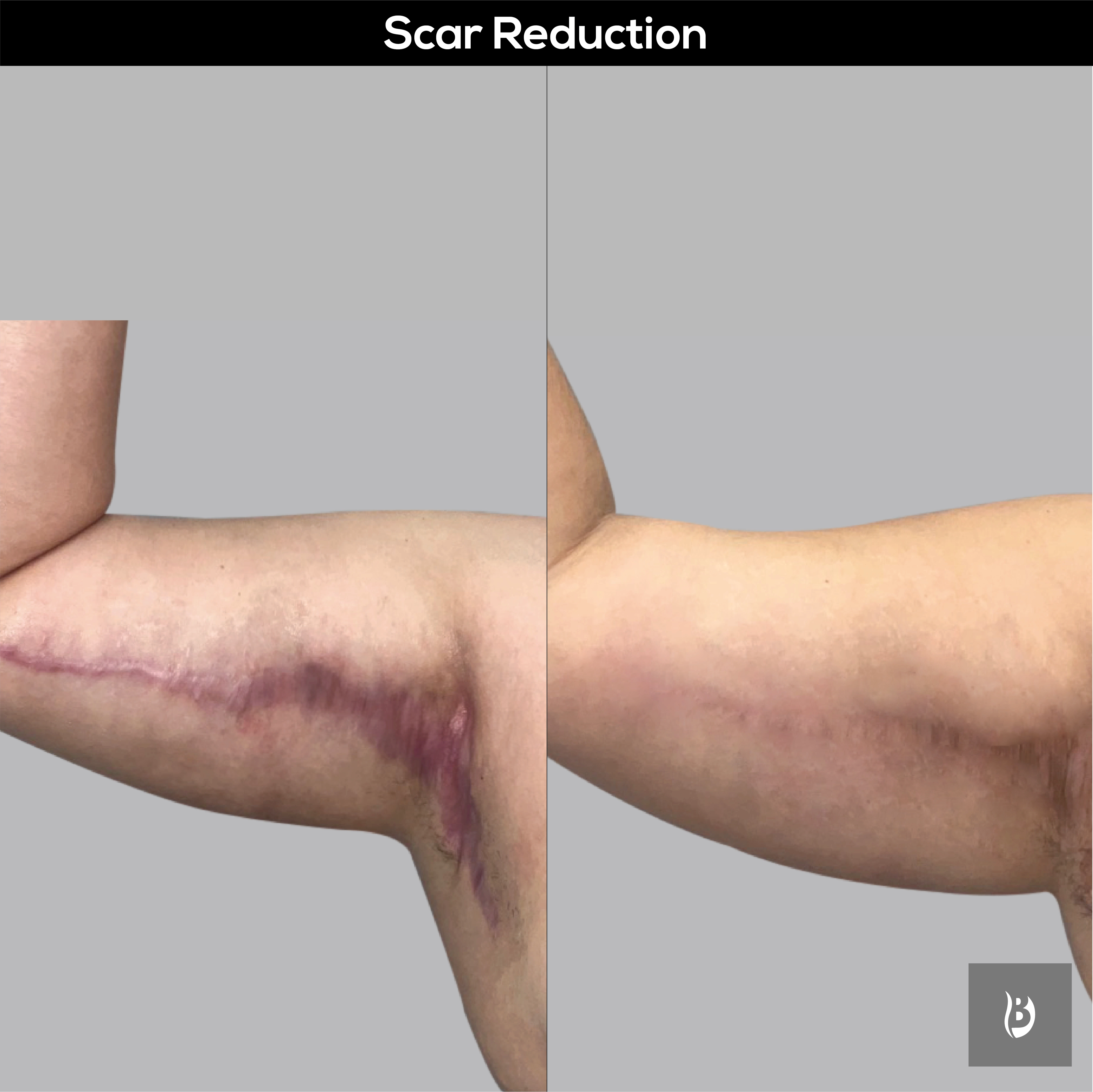 scar reduction