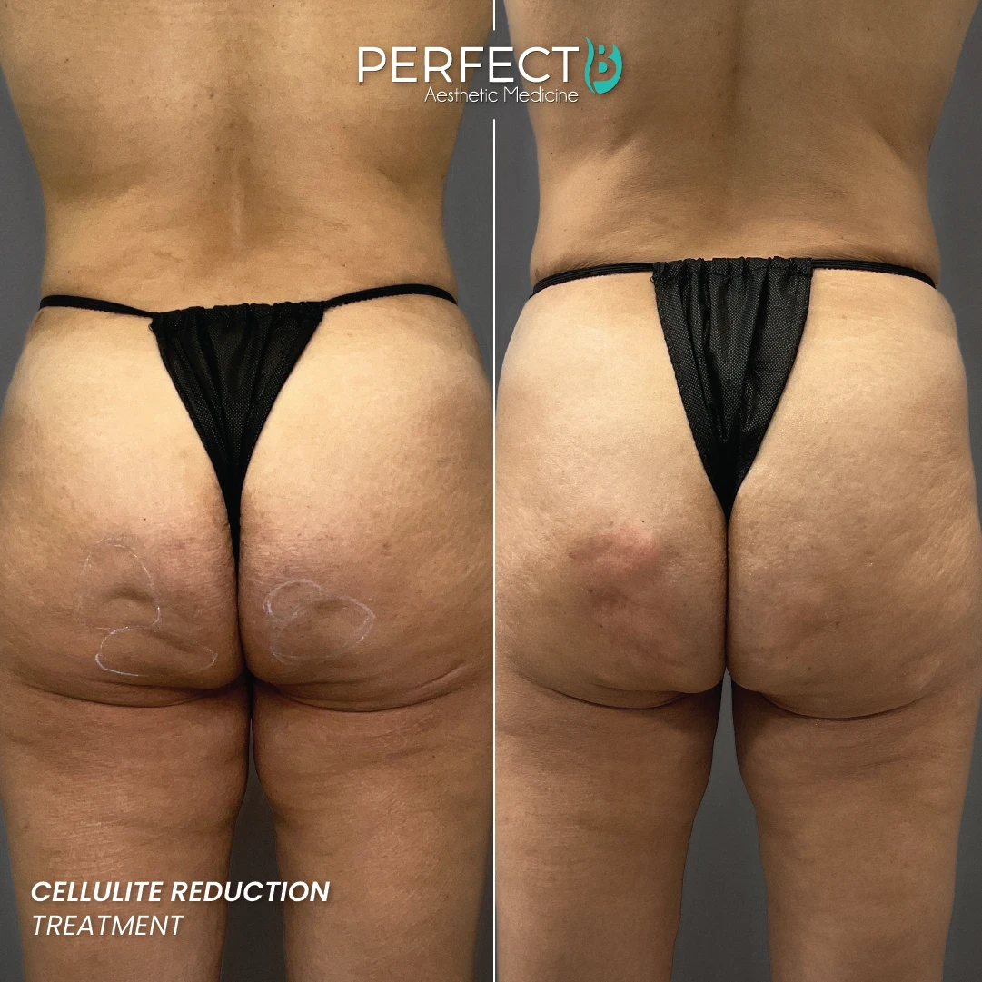 Cellulite Reduction Treatment - Perfect B - Case 4707 - 1080 x 1080