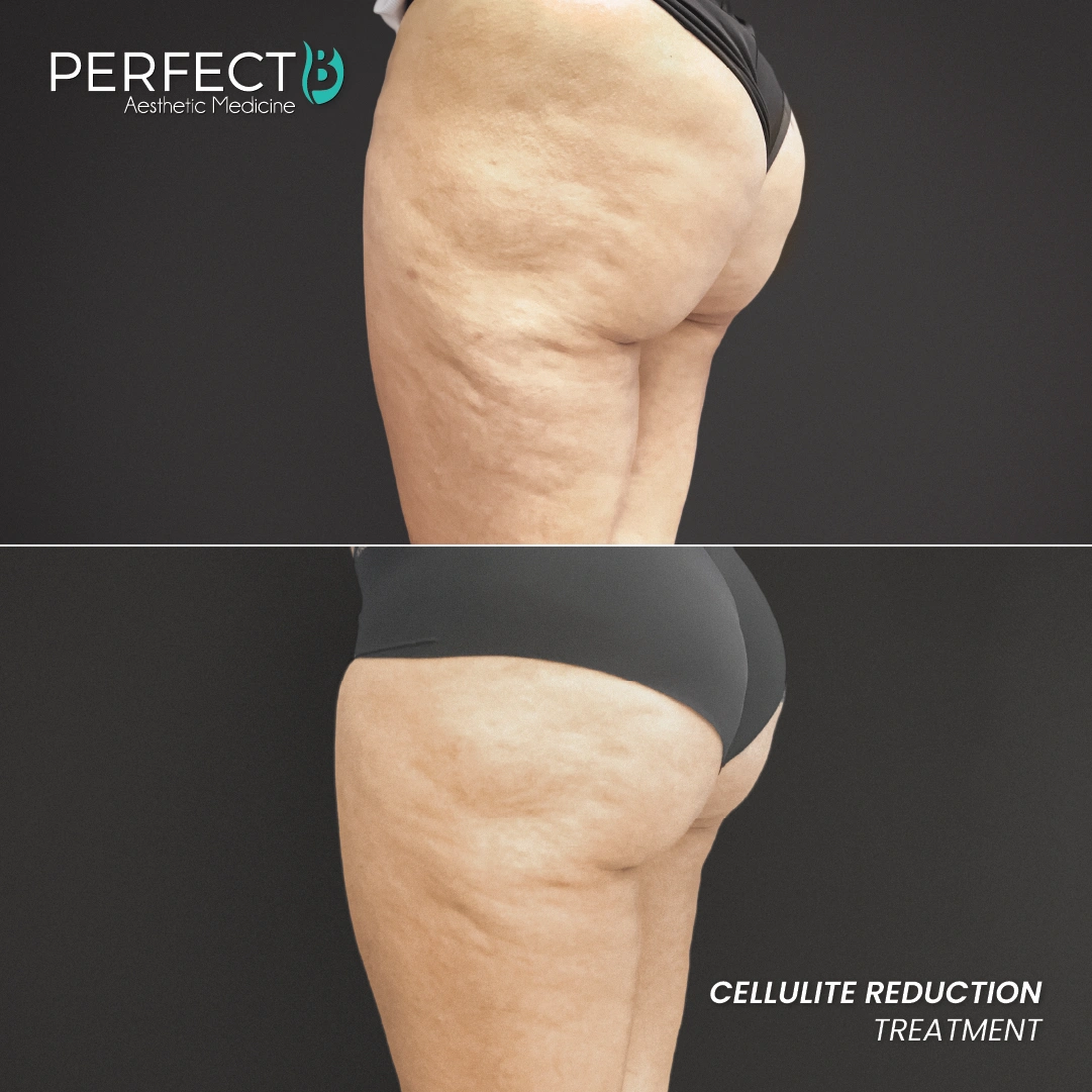 Cellulite Reduction Treatment - Perfect B - Results Image - Case 4702 - 1080 x 1080
