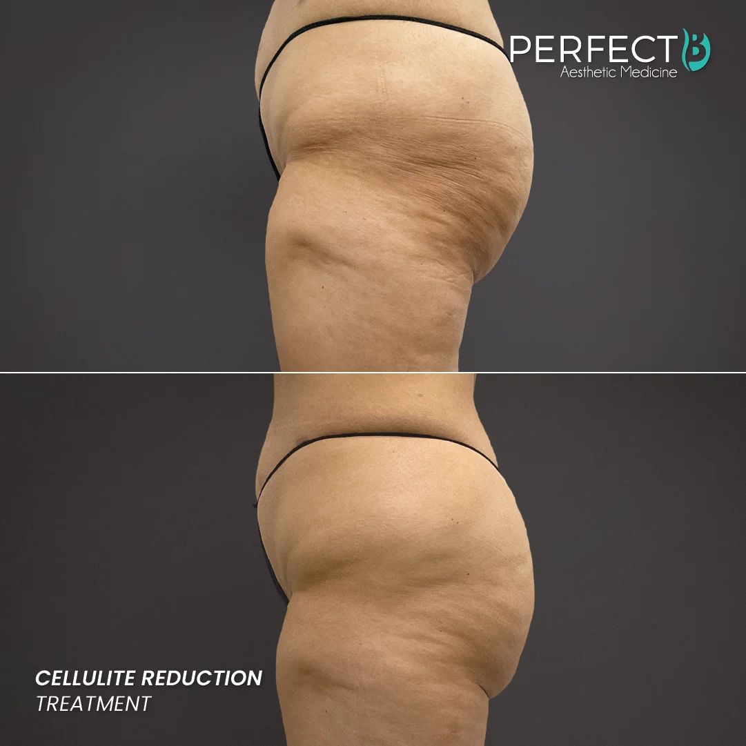Cellulite Reduction Treatment - Perfect B - Results Image - Case 4702 - 1080 x 1080