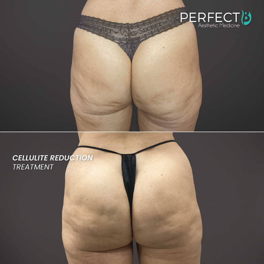 Cellulite Reduction Treatment - Perfect B - Results Image - Case 4706 - 1080 x 1080