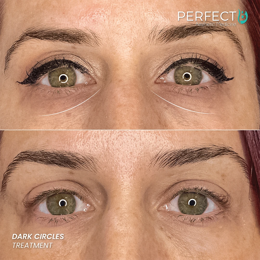 Dark Circles Treatment - Perfect B - Results Image - Case 5203 - 1080 x 1080