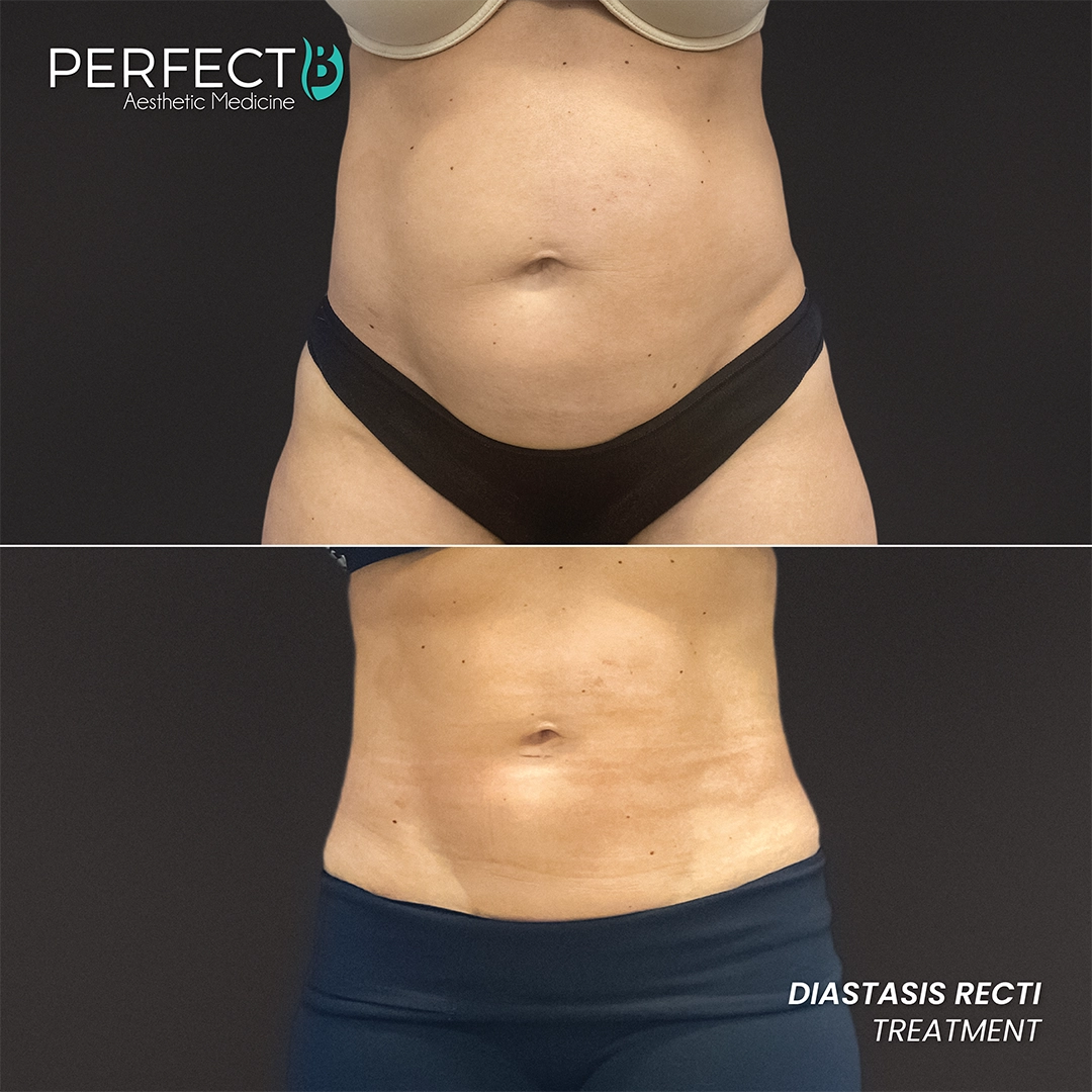 Diastasis Recti Treatment - Perfect B - Results Image - Case 5001 - 1080 x 1080