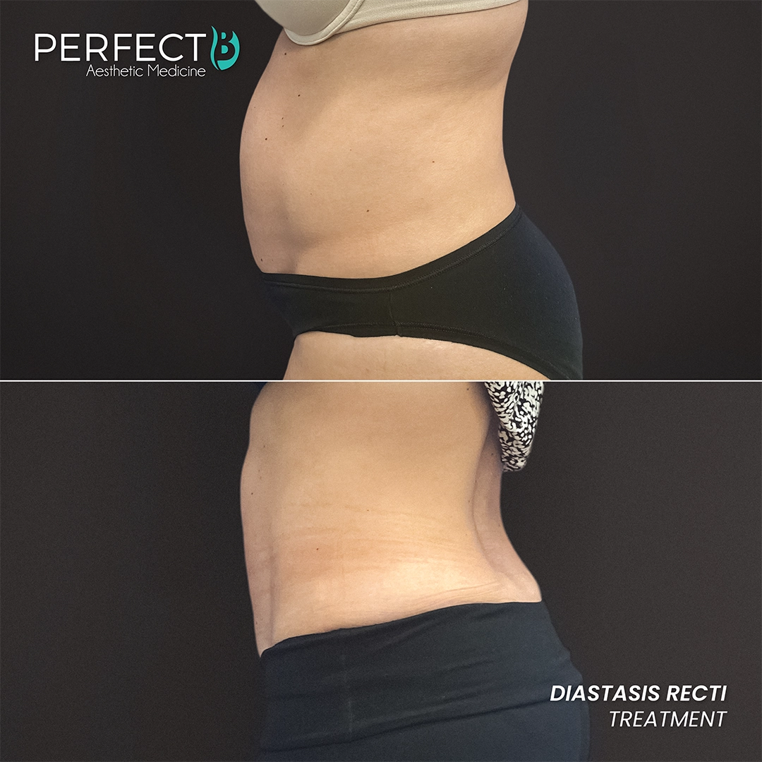 Diastasis Recti Treatment - Perfect B - Results Image - Case 5001B - 1080 x 1080