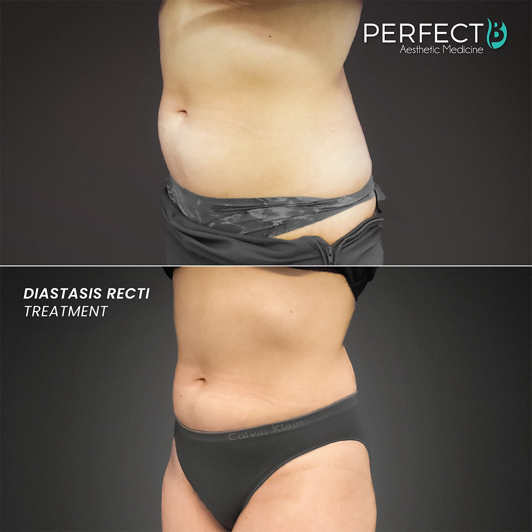 Diastasis Recti Treatment - Perfect B - Results Image - Case 8023 - 1080 x 1080