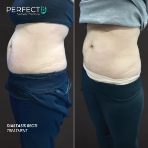 Diastasis Recti -Treatment-Perfect-B-Results-Image-Case-8212 -1080-x-1080
