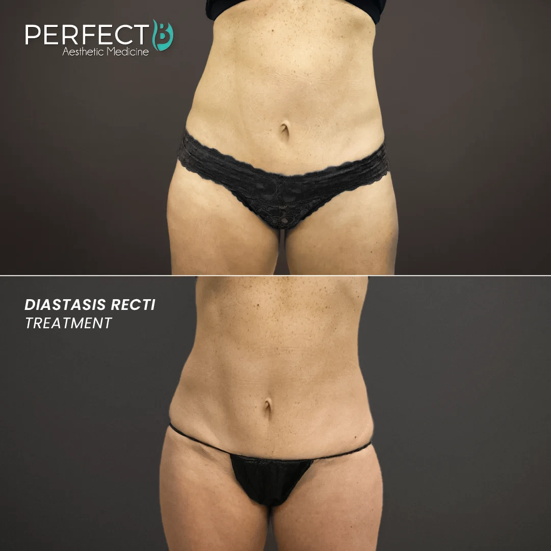 Diastasis Recti Treatment - Perfect B - Results Image - Case 8236 - 1080 x 1080