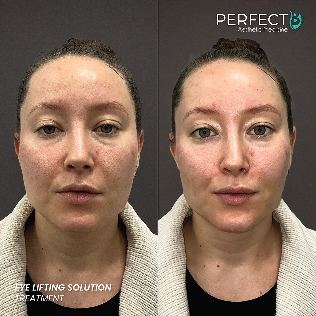Eye Lifting Solution Treatment - Perfect B - Results Image - Case 5102- 1080 x 1080