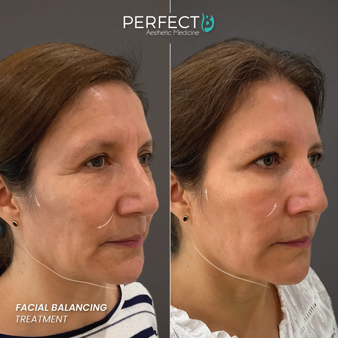 Facial Balancing Treatment - Perfect B - Results Image - Case 5705 - 1080 x 1080