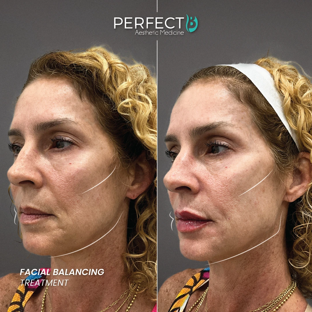 Facial Balancing Treatment - Perfect B - Results Image - Case 5710 - 1080 x 1080
