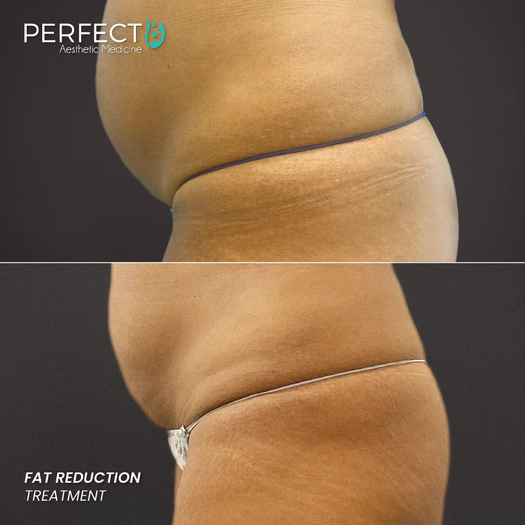 Fat Reduction Treatment - Perfect B - Results Image - Case 590 - 1080 x 1080