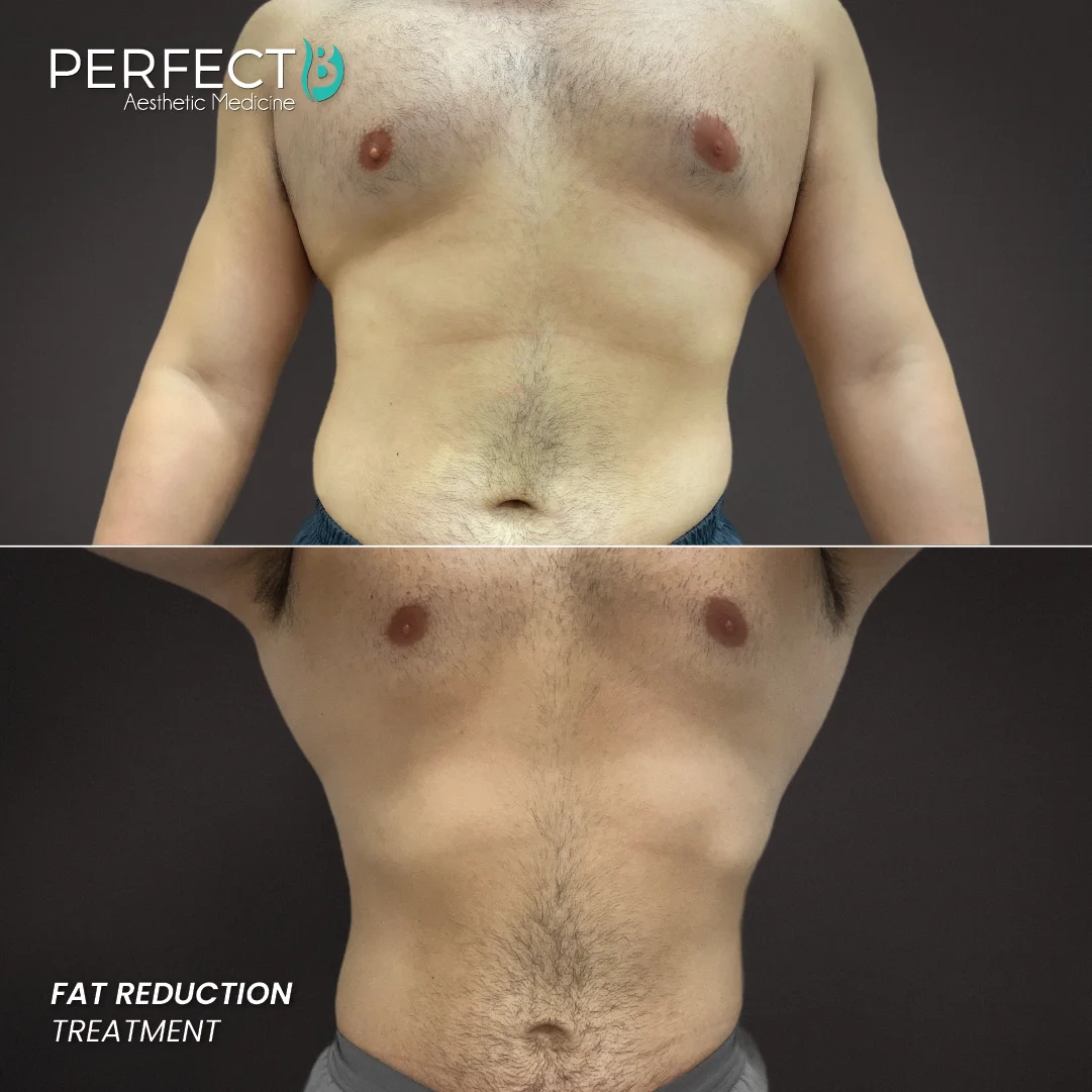 Fat Reduction Treatment - Perfect B - Results Image - Case 5902 - 1080 x 1080