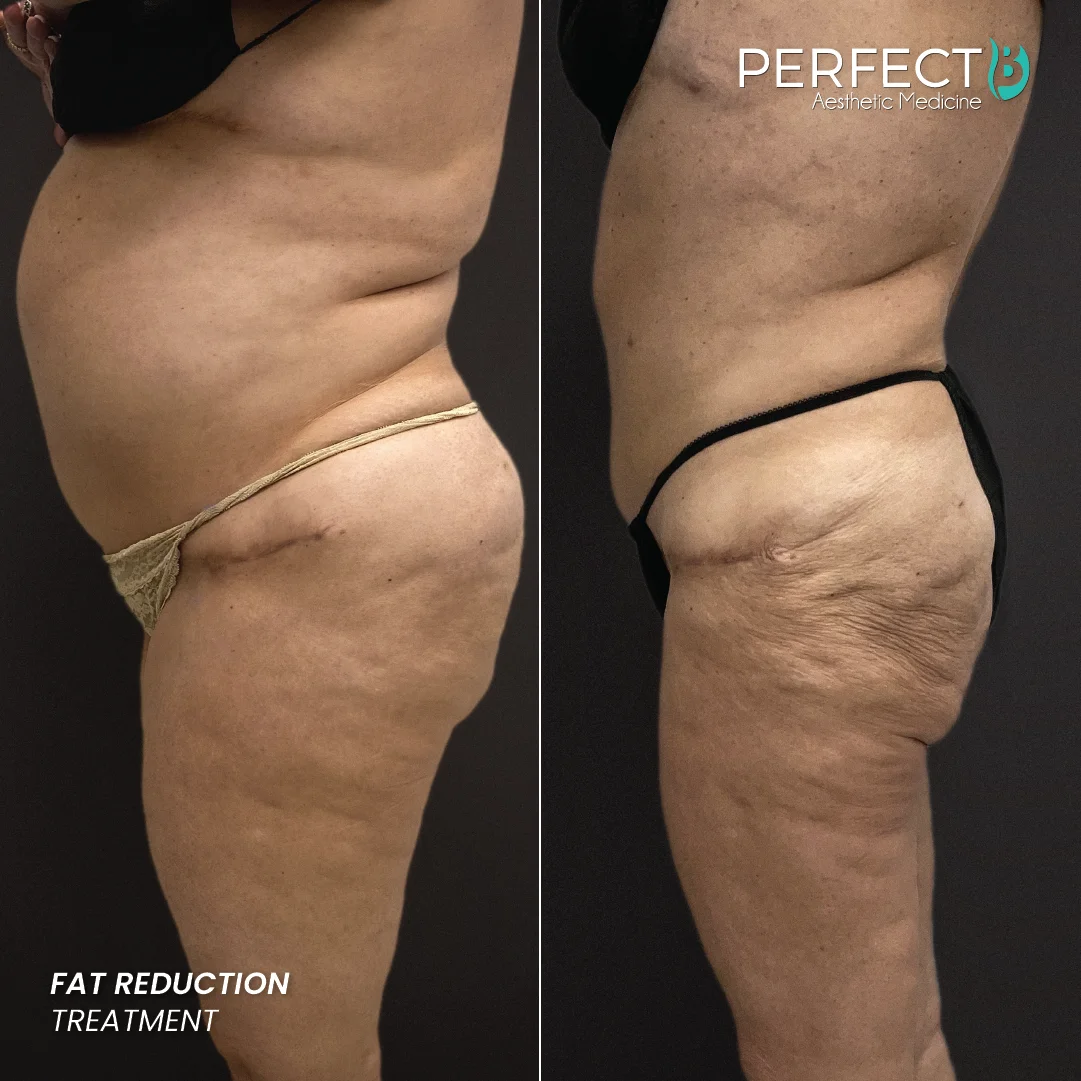 Fat Reduction Treatment - Perfect B - Results Image - Case 5906 - 1080 x 1080