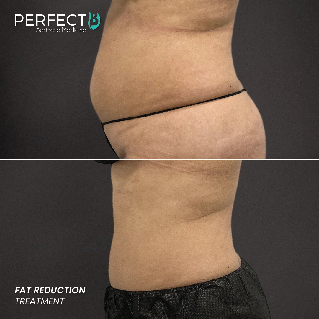 Fat Reduction Treatment - Perfect B - Results Image - Case 5914 - 1080 x 1080