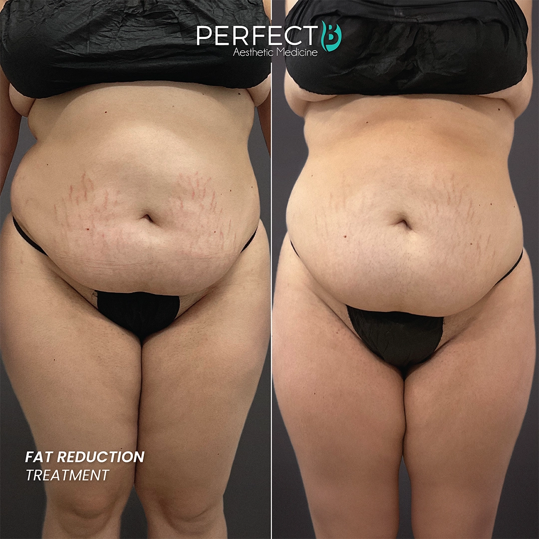 Fat Reduction Treatment - Perfect B - Results Image - Case 5918 - 1080 x 1080