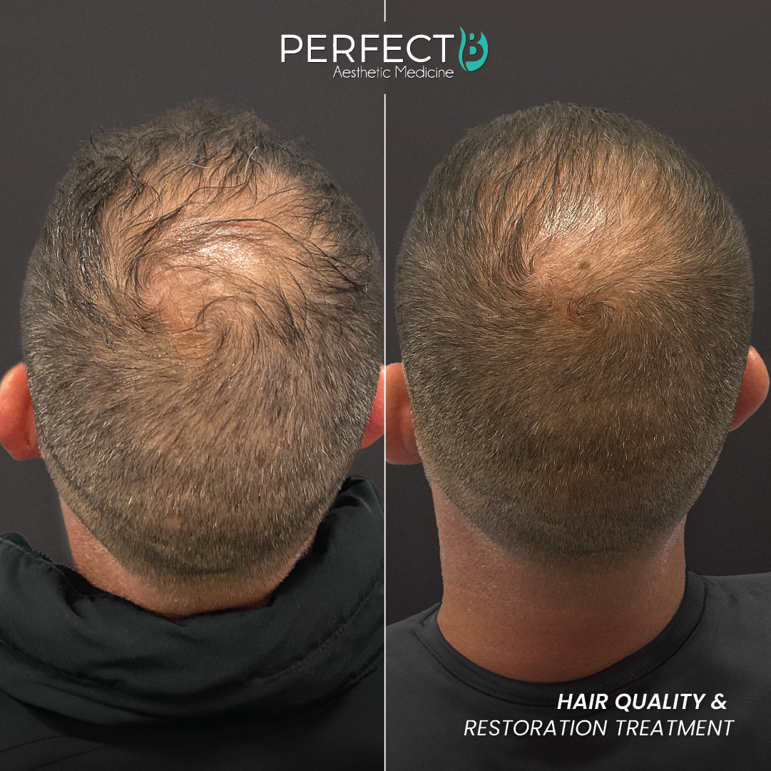 Hair Quality & Restoration Treatment - Perfect B - Results Image - Case 6402 - 1080 x 1080