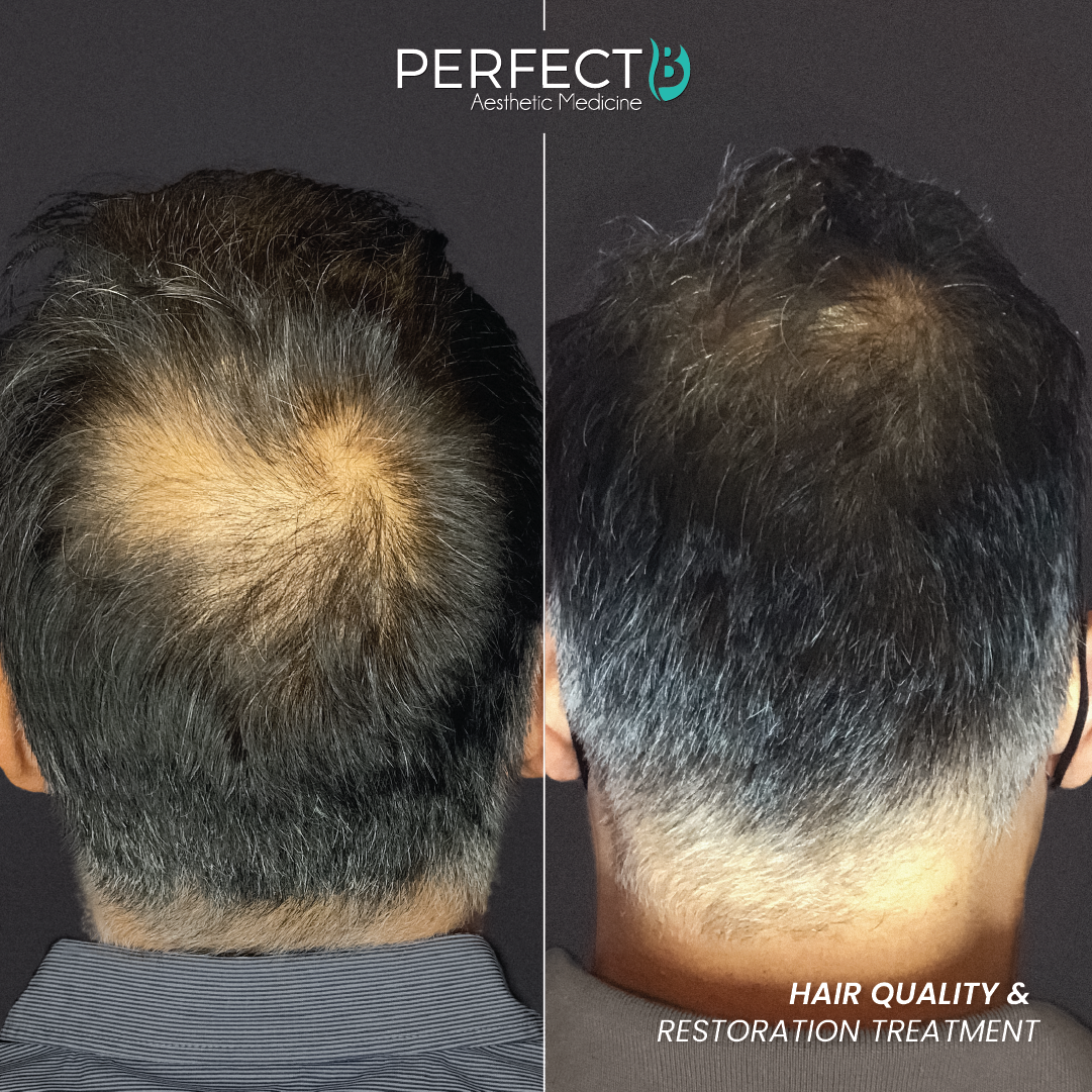 Hair Quality & Restoration Treatment - Perfect B - Results Image - Case 6404 - 1080 x 1080