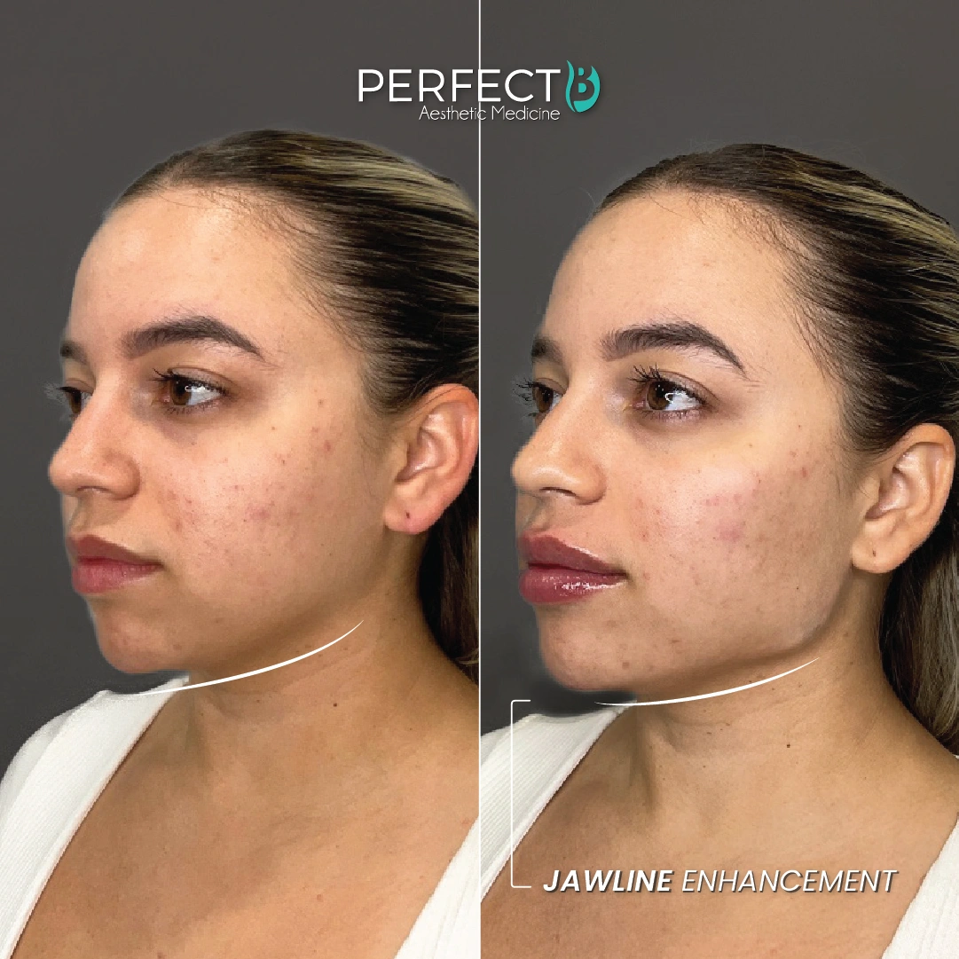 Jawline Enhancement - Perfect B - Case 5026 - Results Picture - 1080 x 1080