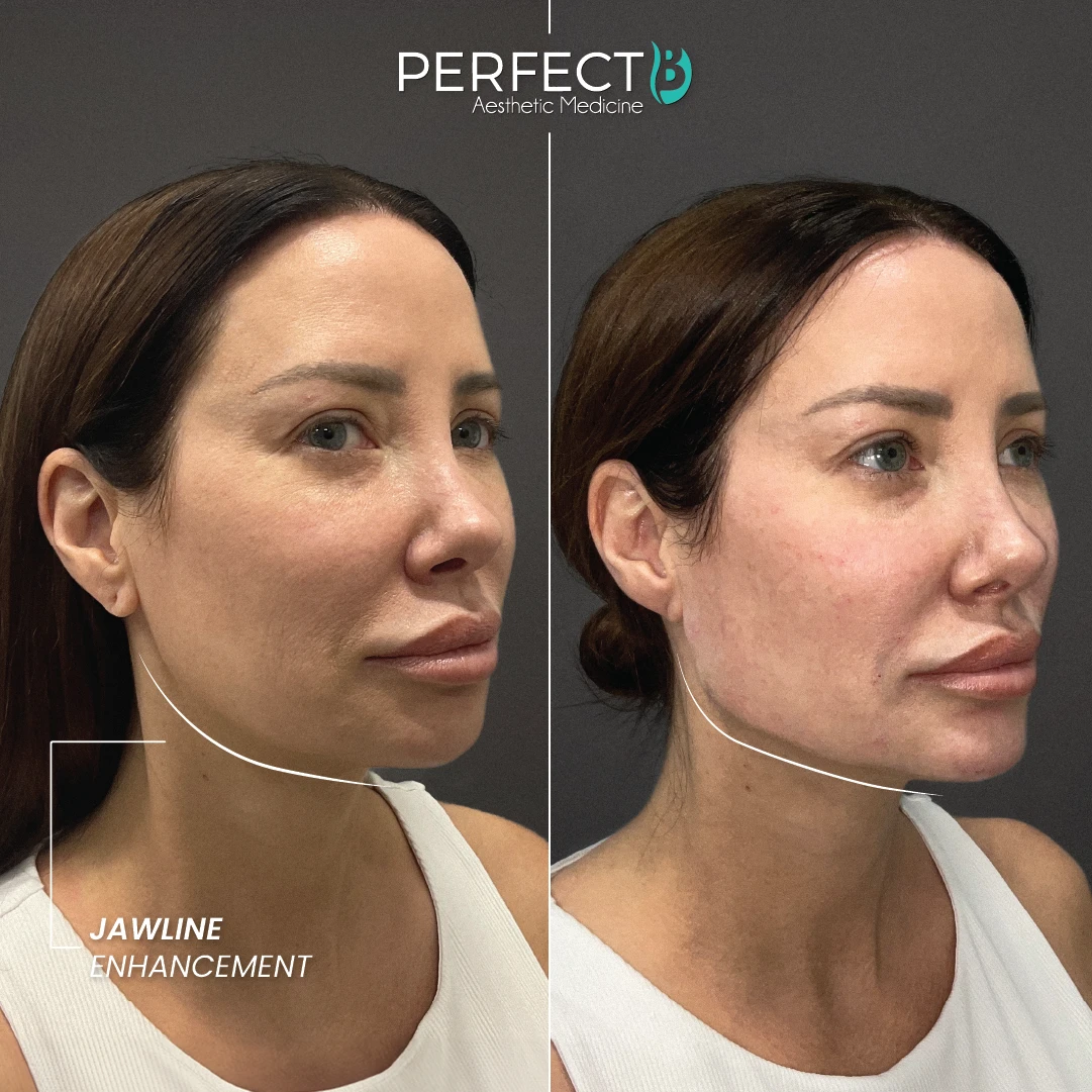 Jawline Enhancement - Perfect B - Results Image - Case 6601 - 1080 x 1080