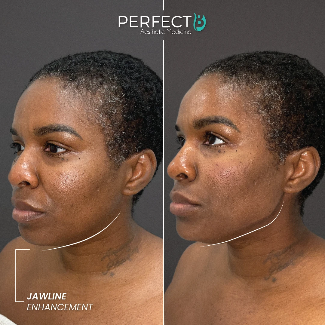 Jawline Enhancement - Perfect B - Results Image - Case 6607 - 1080 x 1080