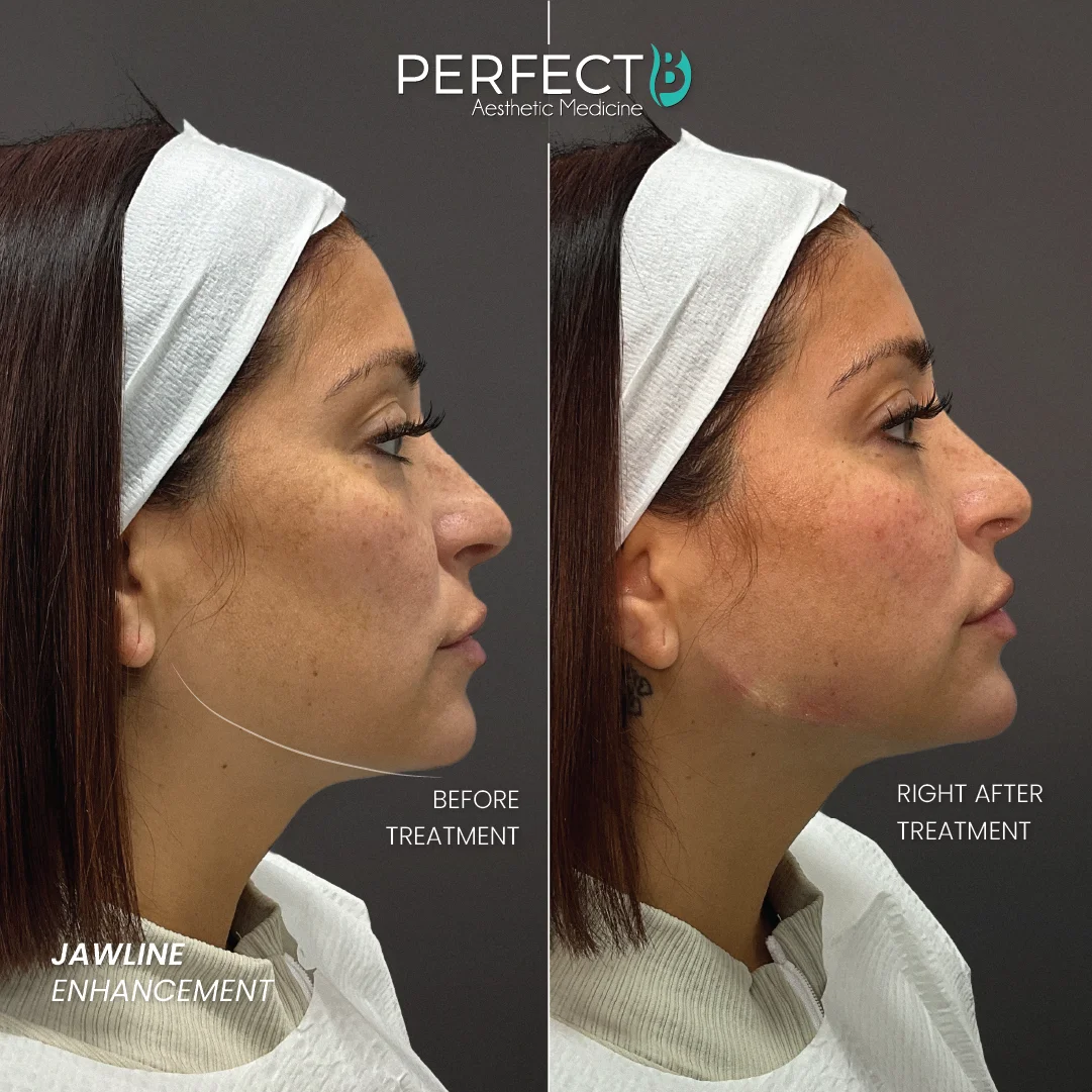 Jawline Enhancement - Perfect B - Results Image - Case 6610 - 1080 x 1080