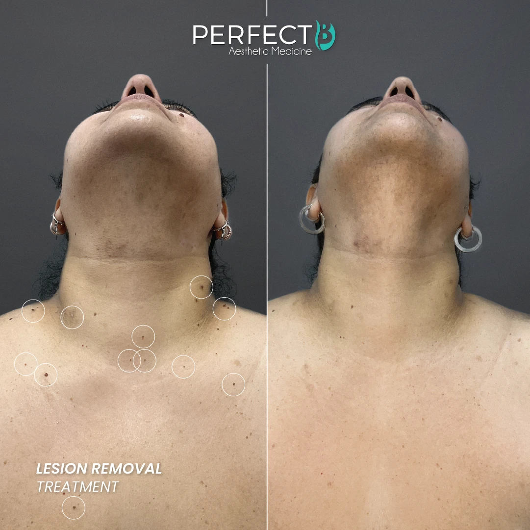 Lesion Removal Treatment - Perfect B - Results Image - Case 7301 - 1080 x 1080