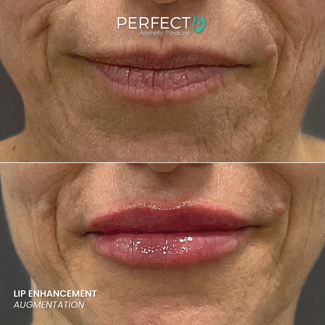 Lip Enhancement Augmentation - Perfect B - Results Image - Case 74 64 - 1080 x 1080