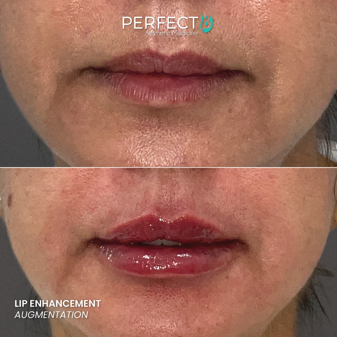 Lip Enhancement Augmentation - Perfect B - Results Image - Case 74 65 - 1080 x 1080