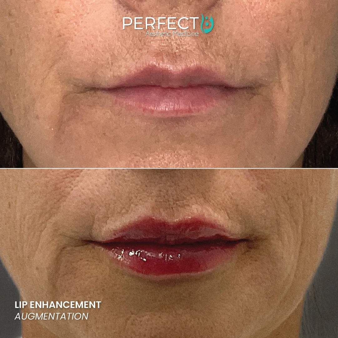 Lip Enhancement Augmentation - Perfect B - Results Image - Case 74 69 - 1080 x 1080